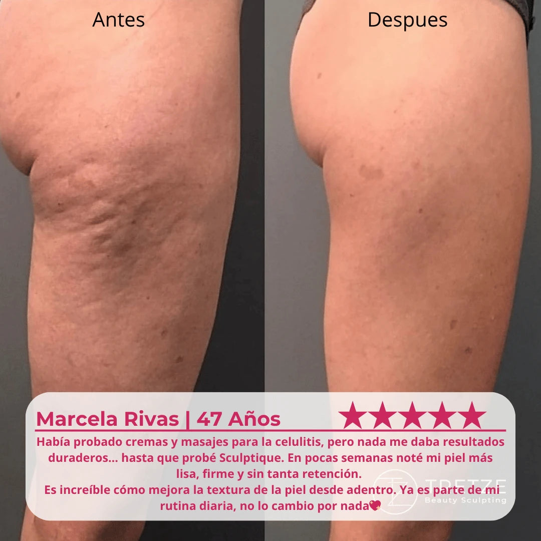Tratamiento de celulitis Sculptique™